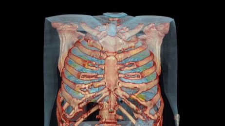 Płuca zniszczone przez COVID-19 fot. kadr z YT/Dr. Mortman GWUH
