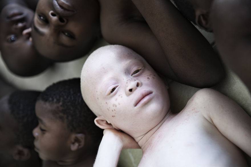 "Under the Same Sun”. Poruszające zdjęcia dzieci -albinosów