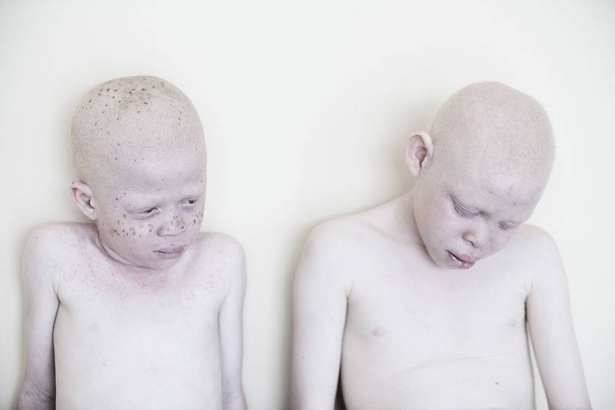 "Under the Same Sun”. Poruszające zdjęcia dzieci -albinosów