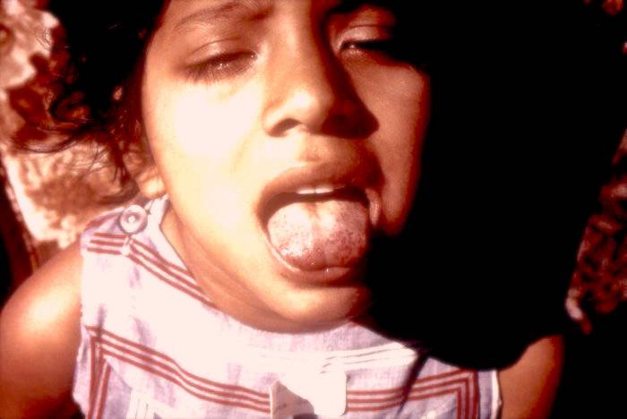 Dziewczynka chora na szkorbut pokazuje zainfekowany język