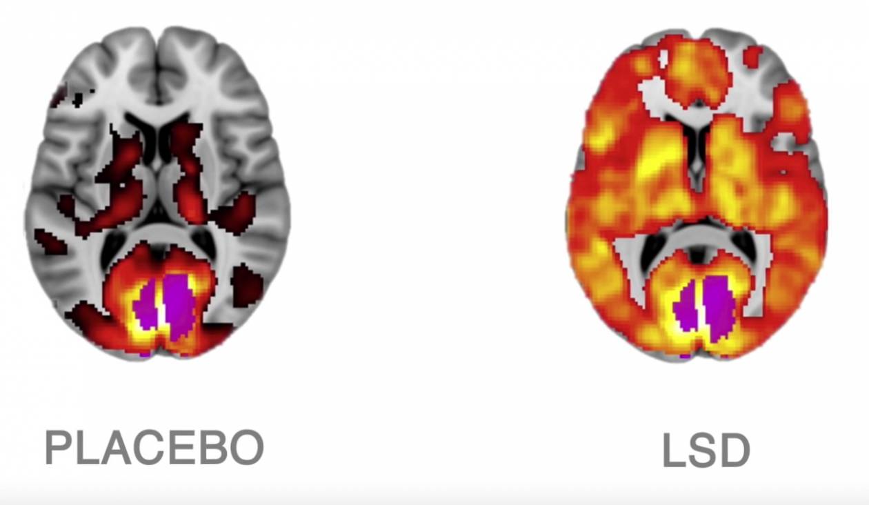 Aktywność mózgu pod wpływem placebo i LSD