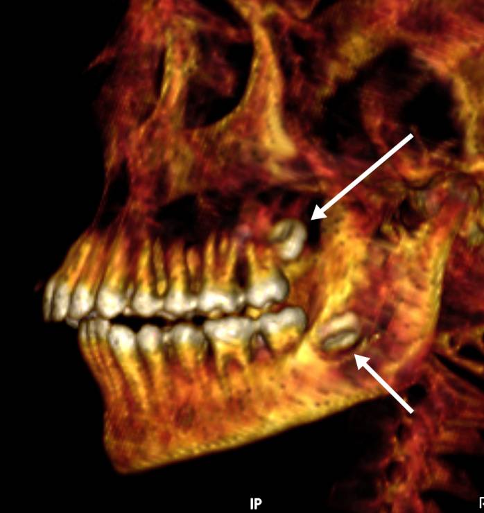 Zęby mądrości, które nie zdążyły się wyrżnąć. Mumia złotego chłopca została rozpakowana cyfrowo. W jej środku znaleziono 49 drogocennych amuletów (fot. SN Saleem, SA Seddik, M el-Halwagy, CC-BY)