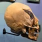 czaszka z implantem
