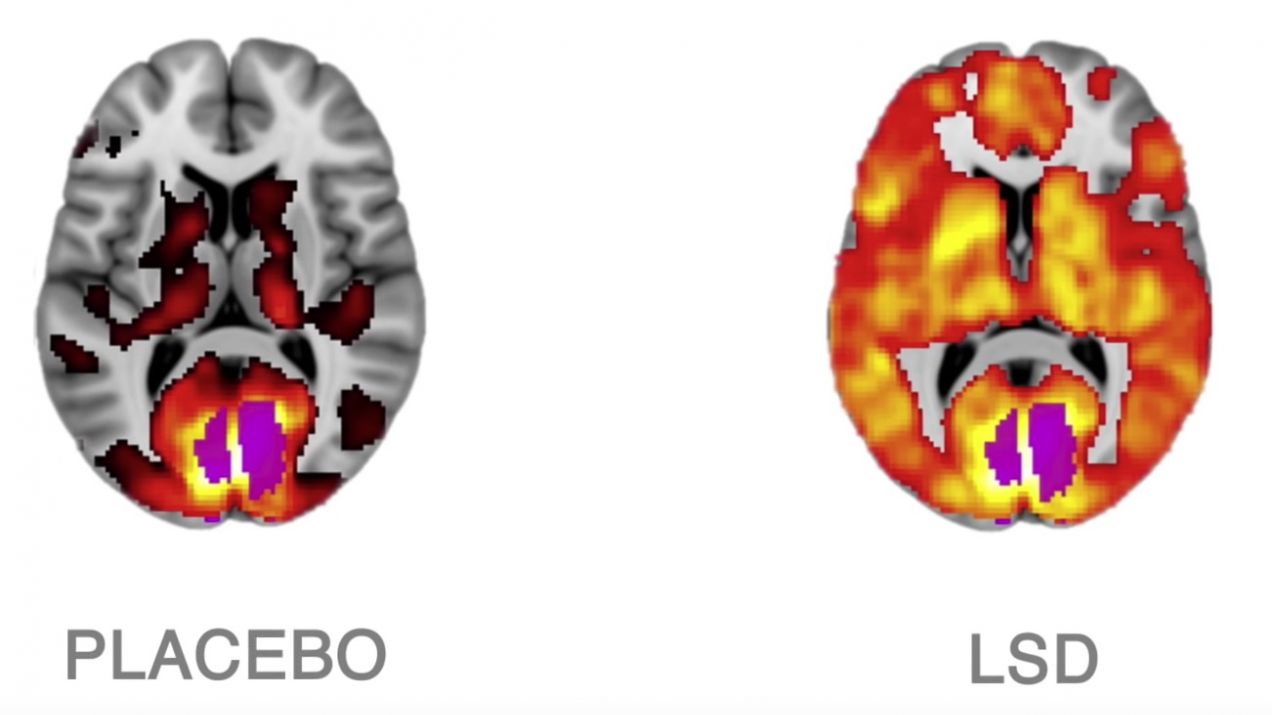 Aktywność mózgu pod wpływem placebo i LSD