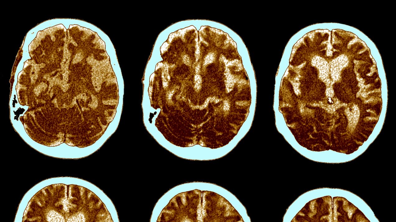 Zmiany w mózgu spowodowane demencją